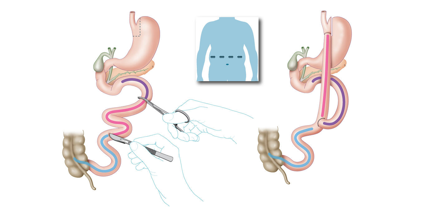 Gastric bypass 